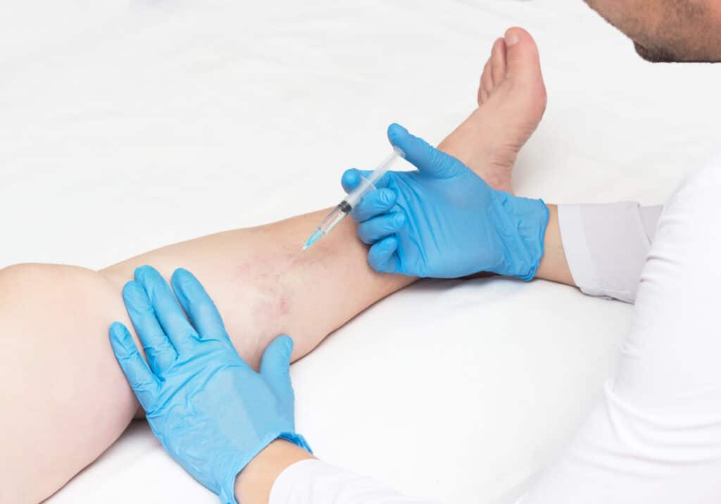 If you have symptoms of underlying vein disease, then you may be wondering how a top vein doctor in SD treats varicose veins and spider veins. In this article, our top vein doctor in SD discusses what you can expect during your treatment.