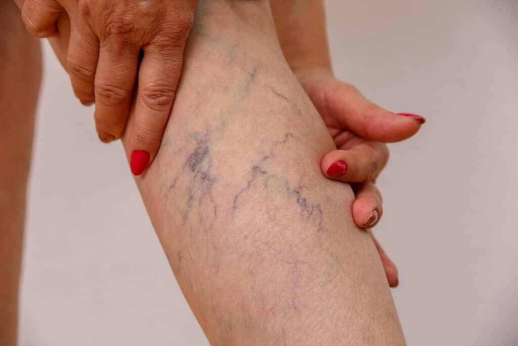 If you have spider veins and varicose veins, you may have plenty of questions to ask, including “How can i find a spider vein clinic near me in SD?” and “How can I find a good vein doctor?”. In this article, medical group experts answer these questions and more.