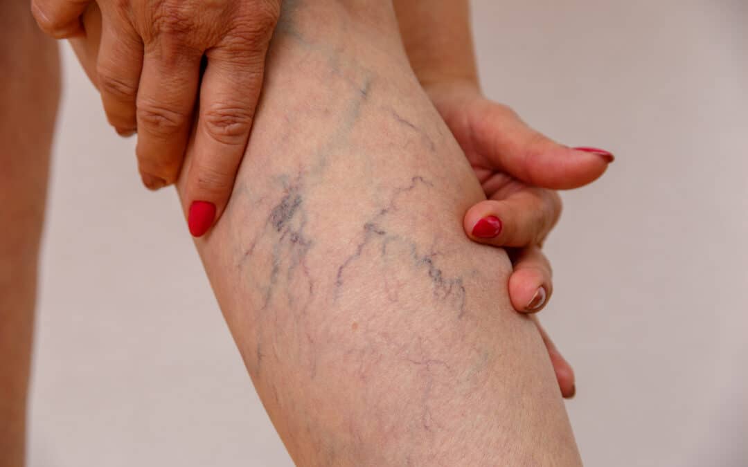 When Should I Consult a Vein Center in CA? An Expert Medical Group Weigh In