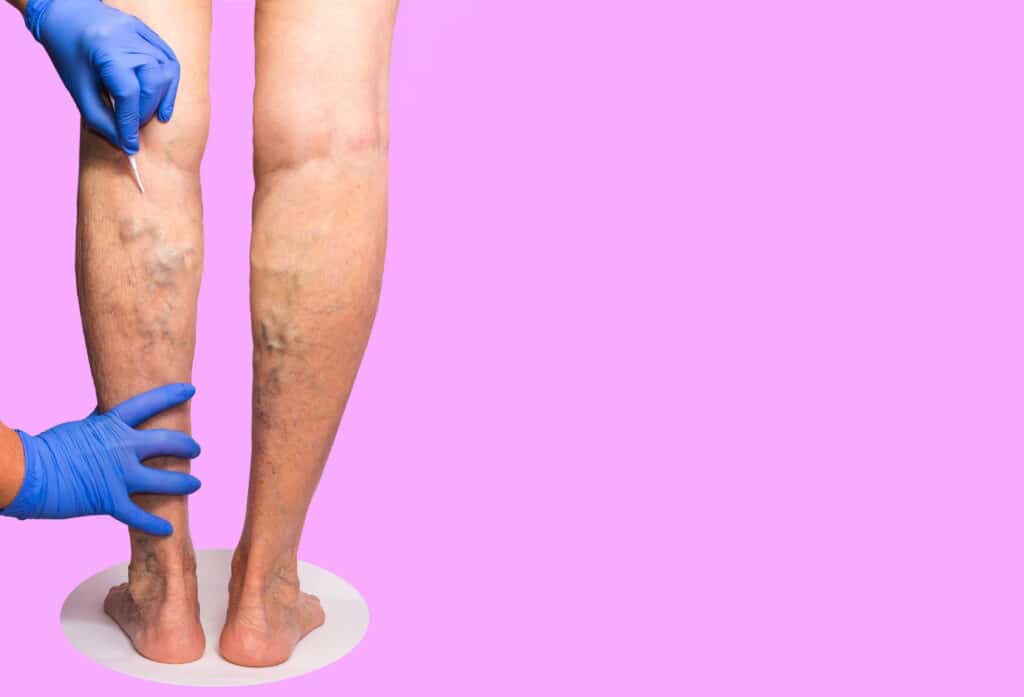 If you are seeking treatment for your spider veins and varicose veins, then you may be wondering “what can I expect from a spider vein center near me in California?” In this article, we discuss the treatment that will be available to you at a top spider vein clinic in California. 