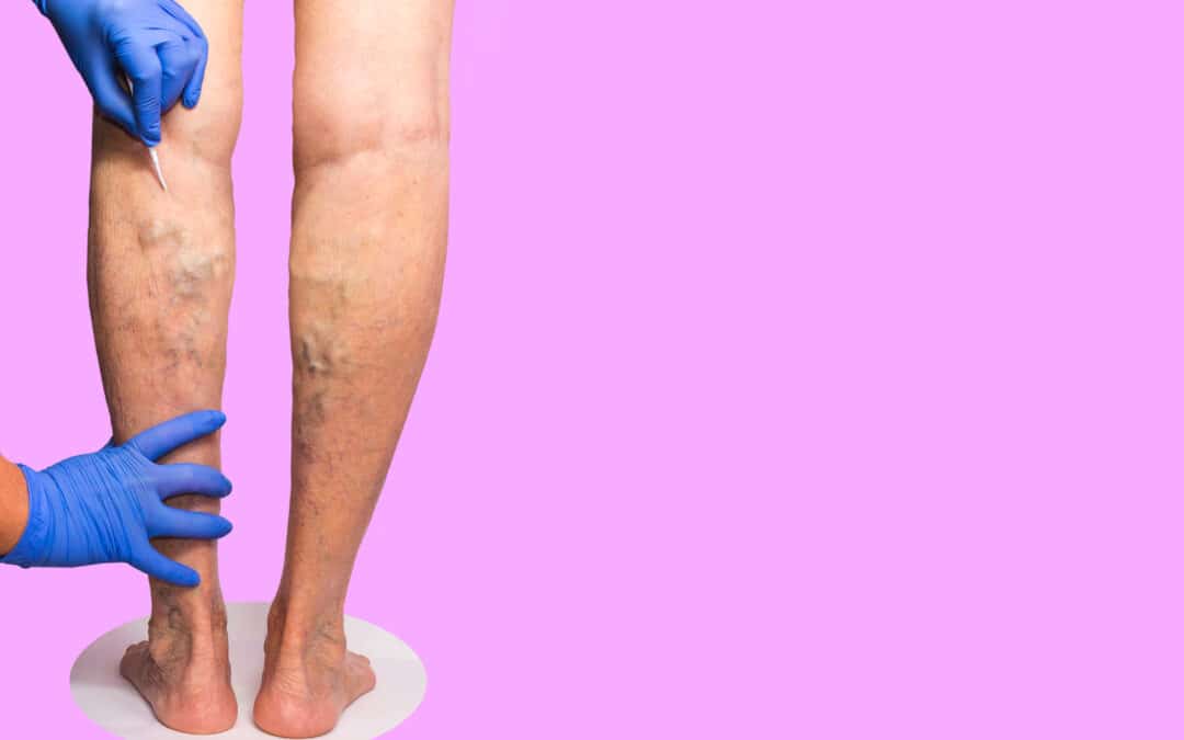What Minimally Invasive Vein Treatments are Available at a Vein Center in California? Find Out From the Experts at a Top Medical Clinic
