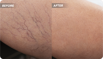 What should I consider when choosing a vein doctor CA that treats varicose veins, spider veins, and other vein diseases? We list qualities to look for when you are searching for the best vein doctor CA to provide you with vein care.