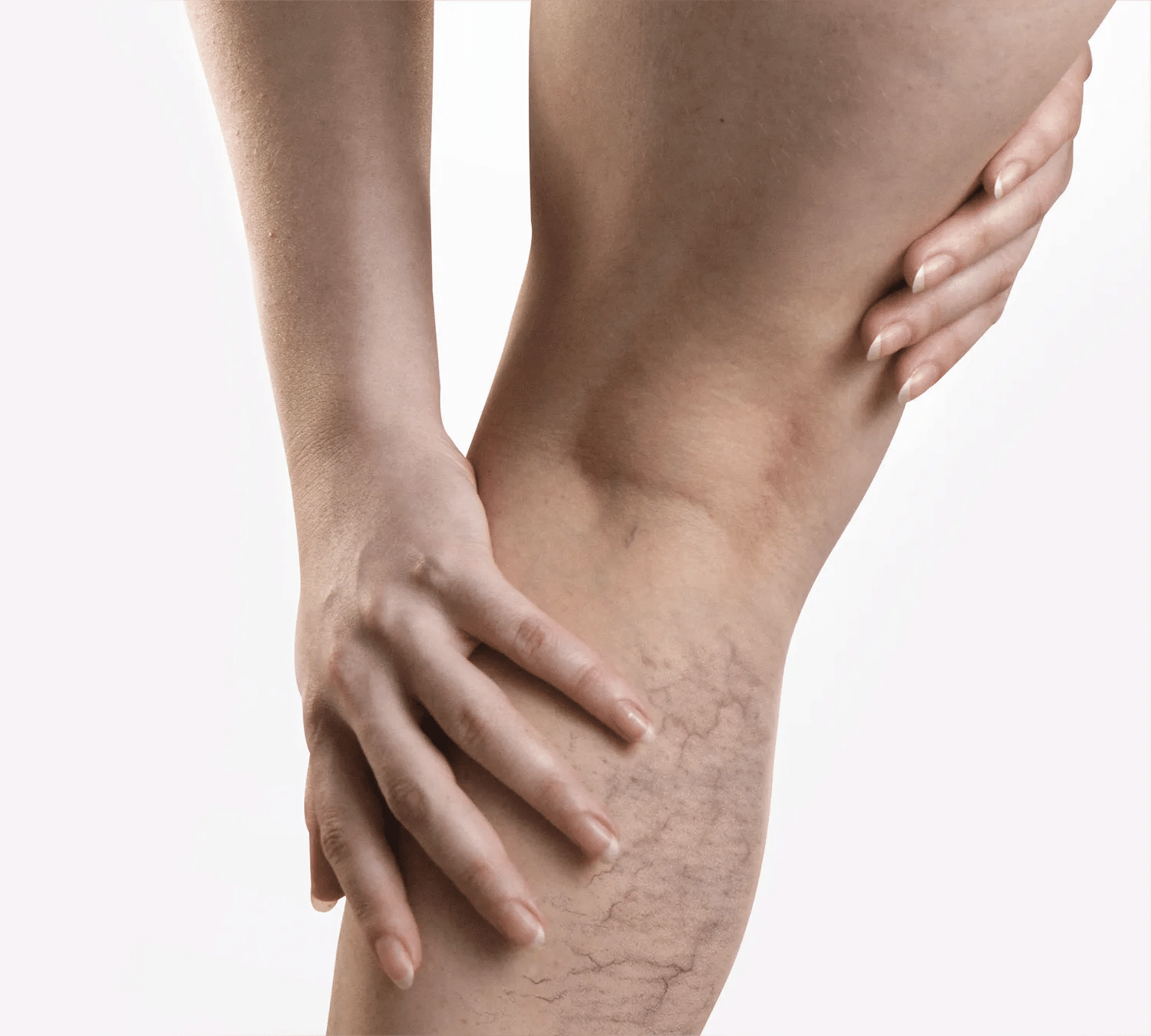 vipcenters_SpiderVeins_treatment_img1