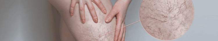 Spider-vein-call-outs
