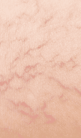 Spider veins