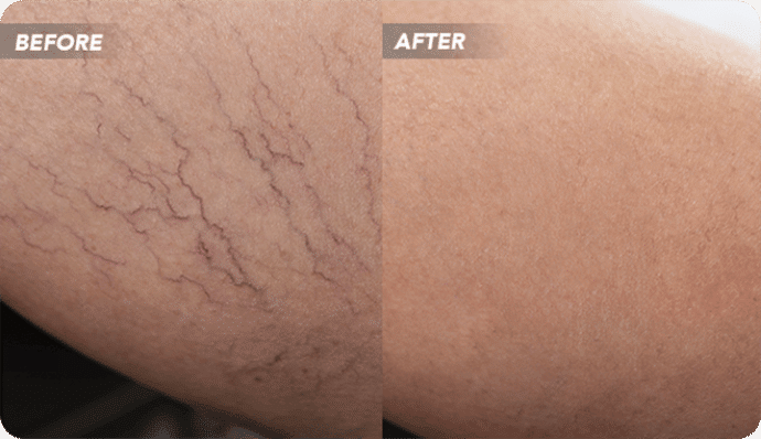 VTCBefore-After