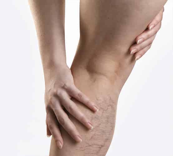 vipcenters_SpiderVeins_treatment_3