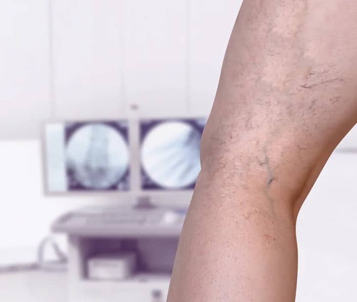 What would happen if I let my varicose veins go untreated, or if I seek treatment from an unreputable clinic? Highly trained varicose vein doctors in NYC talk about five risks of not seeking treatment for varicose veins or getting treated in the wrong place.